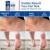 Skin Tag Remover, Extra Strength Skin tag Removal, Wart Remover, Fast-Acting Tag Dry and Fall Away, Suitable for All Skin Types