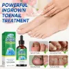 Ingrown Toenail Treatment, Professional & Safe & Efficient, for Paronychia Caused by Ingrown Toenail, 30ml