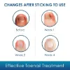 Ingrown Toenail Treatment, Ingrown Toenail Corrector Strips, Professional & Safe & Efficient, for Paronychia Caused by Ingrown Toenail, 50 Pcs, with 2 professional pedicure tools